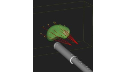 Robotik MR Füzyon Perineal Prostat Bİyopsi